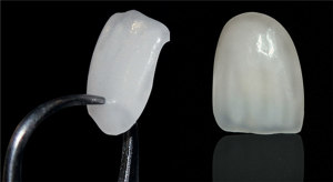 lentes-de-contato-dentais02 (1)