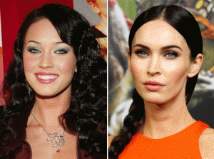 Estrelas como Megan Fox, Angelina Jolie entre outras, são conhecidas por terem se submetido à Bichectomia, por isso a cirurgia é chamada de “cirurgia das estrelas” e bem popular principalmente nos Estados Unidos.